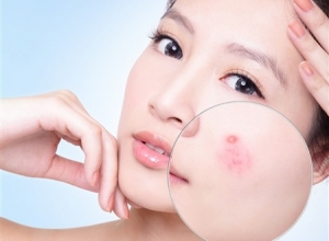  Tại sao uống thuốc giải độc gan bị nổi mụn? - Những sai lầm khi dùng thuốc bổ gan không đúng cách